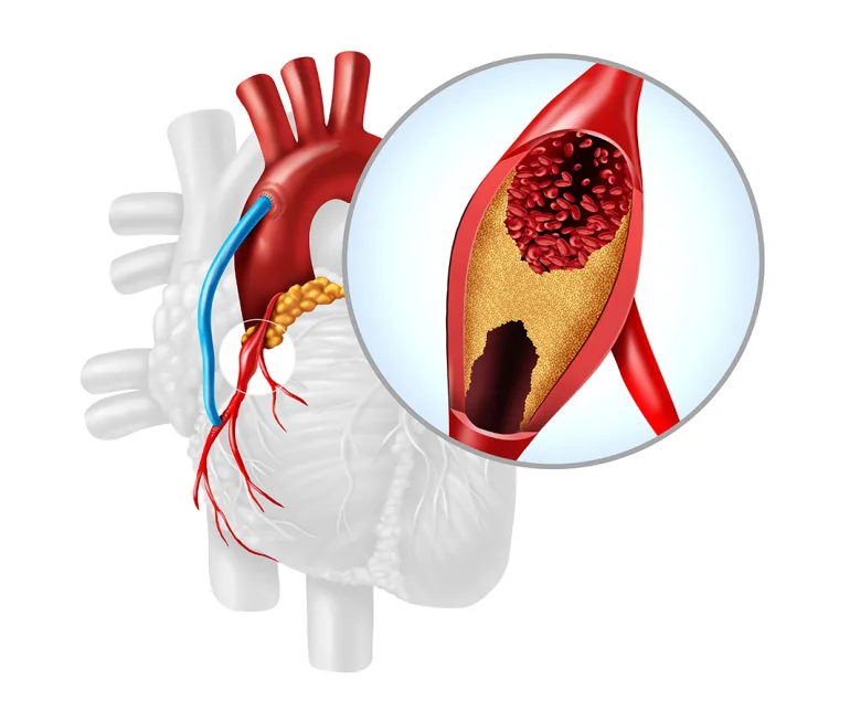 Eligibility Criteria for Closed Bypass Surgery